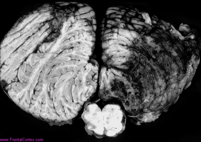 Right posterior inferior cerebel